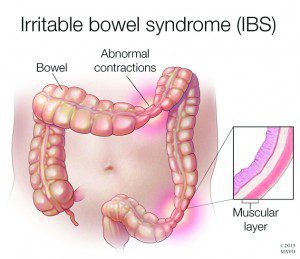 Do You Suffer with IBS