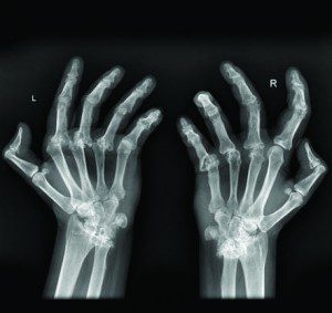 Arthritis: What is it, and what can I do for it