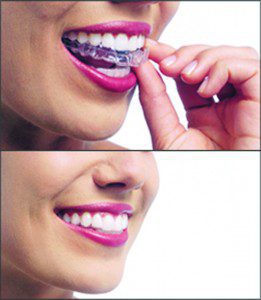 Benefits of Invisalign  and Straight Teeth