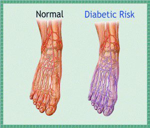 Neuropathy and the Diabetic Patient