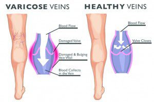 Painful Varicose Veins