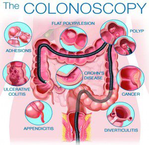 Regular Colon Screening Prevents Cancer