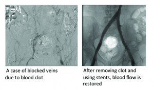 Deep Vein Clots