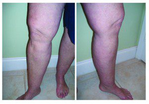 Debunking the Myth of Cankles