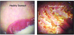 Stomach Ulcer Causes, Treatment & Prevention