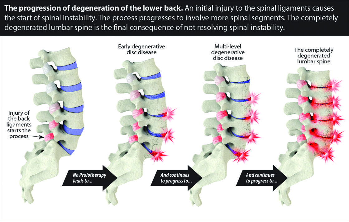 Effective Regenerative Medicine Options For Chronic Back Pain 