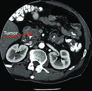 Diagnostic Imaging for Ovarian Cancer