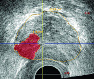MRI-Guided Biopsies Detect Prostate Cancer