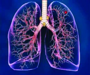 New Technology Detects  Lung Cancer in Early Stage