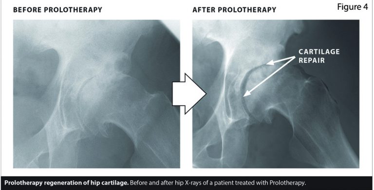 Regenerative Treatments For Labral Tears And Osteoarthritis Of The Hip • Southwest Floridas 