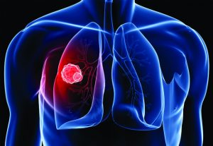 Lung Cancer  and the Importance of Early Detection