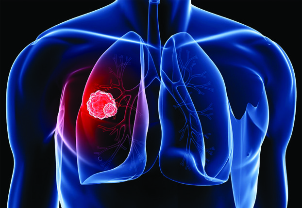 Lung Cancer And The Importance Of Early Detection – Southwest Florida's ...