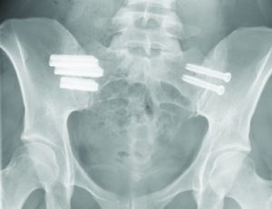 Sacroiliac (SI) Joint Dysfunction2