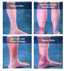 NEW HORIZONS IN VARICOSE VEIN THERAPY