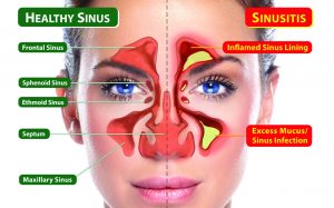 Say Goodbye to Your SINUS PAIN