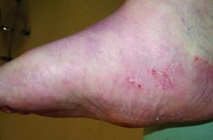 Charcot Foot Deformity Why Diabetics Should Be Concerned