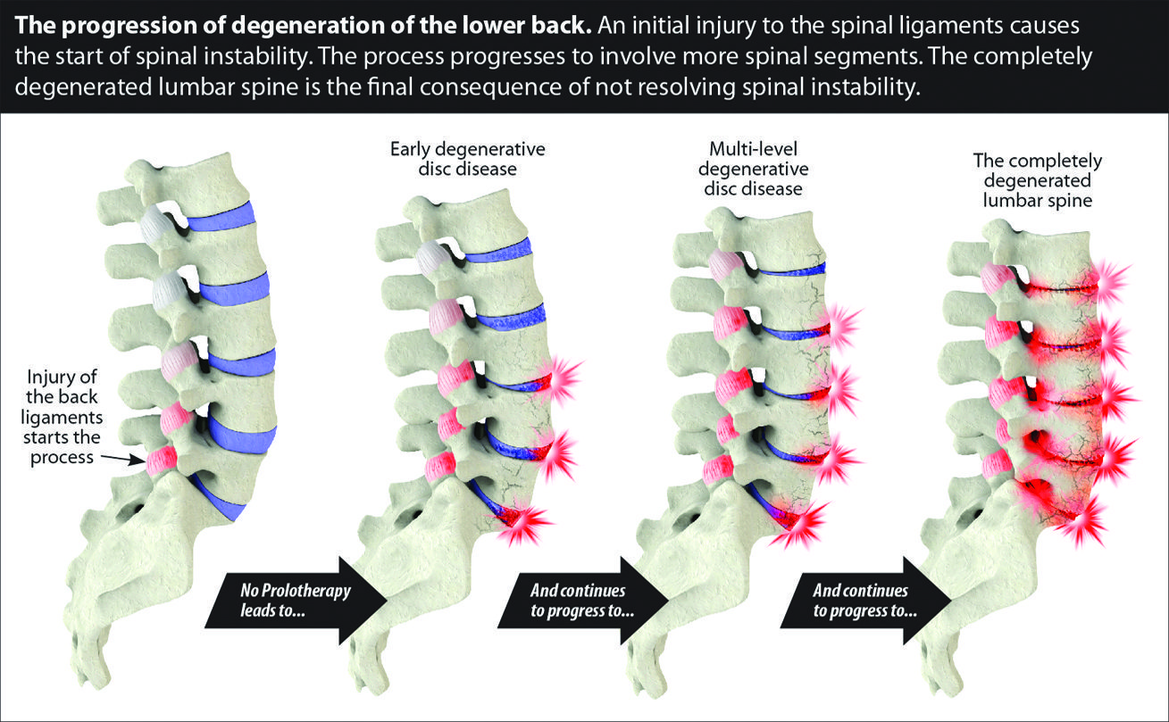 An Alternative to Surgery for Back Pain • Southwest Florida's Health ...