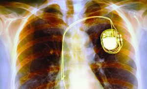 How Pacemakers Are Saving Women’s LivesHow Pacemakers Are Saving Women’s Lives