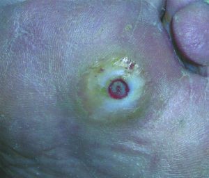 The Life-Threatening Complications of  Diabetic Foot Wounds