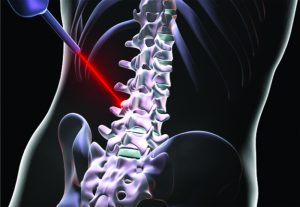 Can Laser Spine Surgery Fix Your Back Pain?