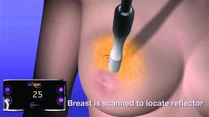 Cosmetic Breakthroughs In Breast Cancer Surgery