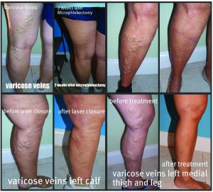 Top 6 Reasons to Get Your Leg Vein  Evaluation and Treatment this FALL.