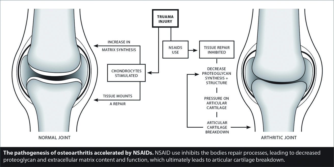 Treatment Options for Osteoarthritis of the Hip • Southwest Florida's