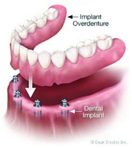 Understanding Dental Implants Part 2