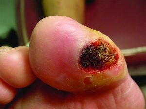 You Need to Know the Truth About  the Dangers of Diabetic Foot Wounds