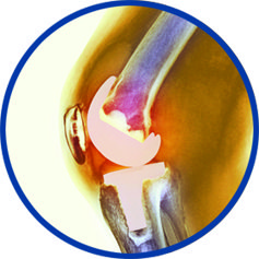 Not All Knee Replacement  Surgeries Are Equal