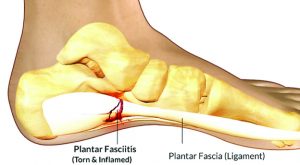 Sports & Activity Related  Foot & Ankle Injuries