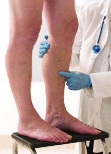 Deep Vein Thrombosis Are You At Risk?