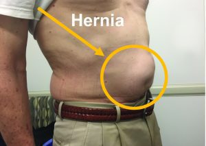 What is That Lump in My Belly? Another article on hernias? Yes, they are that important. And that common.