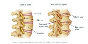 Osteoarthritis…  Is there any hope?