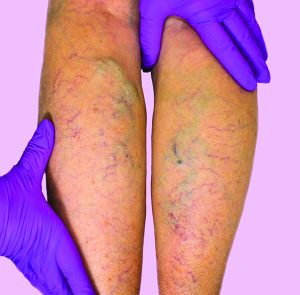 Swollen Legs and Venous Insufficiency