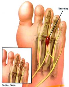 Neuromas: A Painful Foot Condition