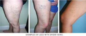 Spider Veins – Cosmetic Concern or Tip of the Iceberg?