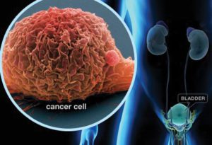 Bladder Cancer - What You Need To Know 