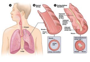 Figure A shows the location of the lungs and airways in the body. Figure B shows a cross-section of a normal airway.  Figure C shows a cross-section of an airway during asthma symptoms.