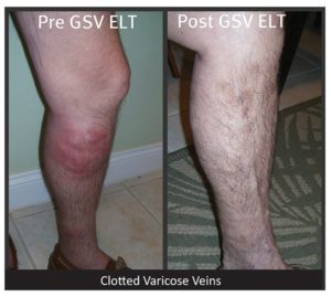 Top 6 Reasons to Get Your Leg Vein Evaluation and Treatment this Fall