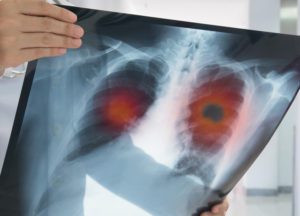 Lung Cancer & The Importance of Screenings