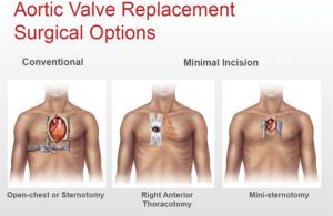 Valvular Heart Disease & Aortic Stenosis