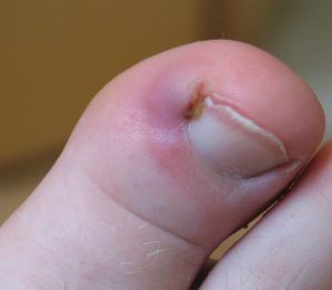 Treating Ingrown Toenails