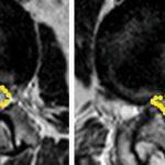 Lumbar Spinal Stenosis