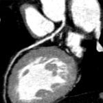 Cardiac CT to Determine Heart Health