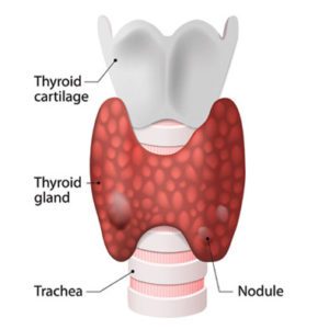 Do You Have A Thyroid Disorde