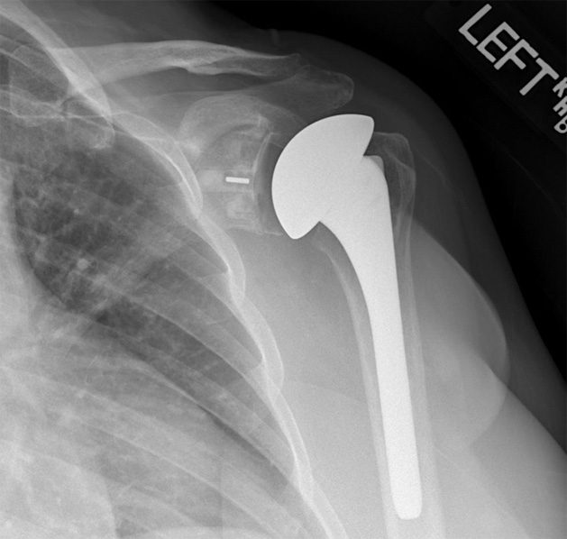 SHOULDER REPLACEMENT DONE WITHOUT A HOSPTIAL STAY? Local surgeon utilizes new, innovative
