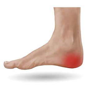 Heel Pain How do you get rid of it