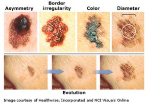 Melanoma... The Most Dangerous form of Skin Cancer