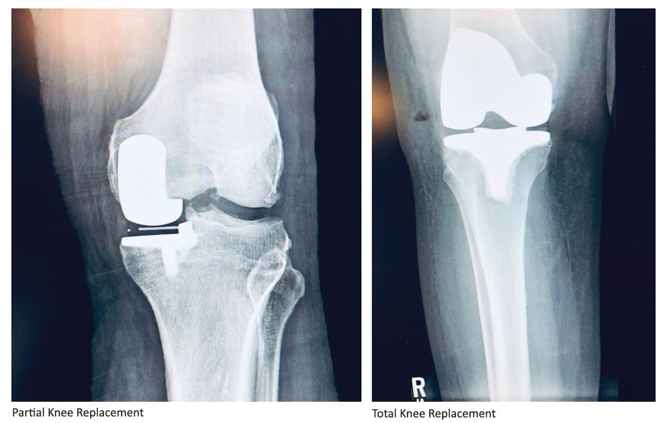 OUTPATIENT PARTIAL KNEE REPLACEMENT Local surgeon utilizes